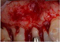 미세 치근단 수술 과정